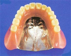 チタン製義歯(入れ歯)